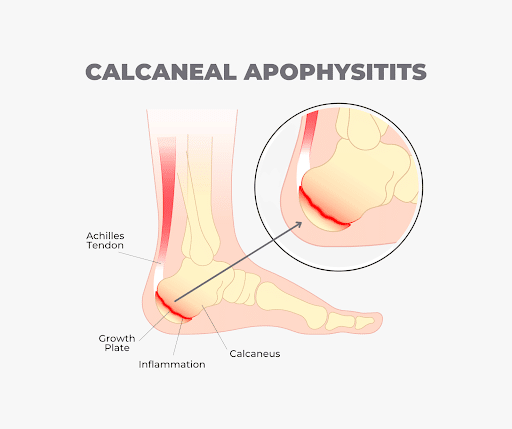 Is your child complaining of sore heels? – Whittlesea Podiatry